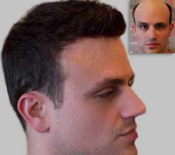 Burbank Hair Replacement System Gallery, Hair pieces, wigs for men : Actual  image hair replacement